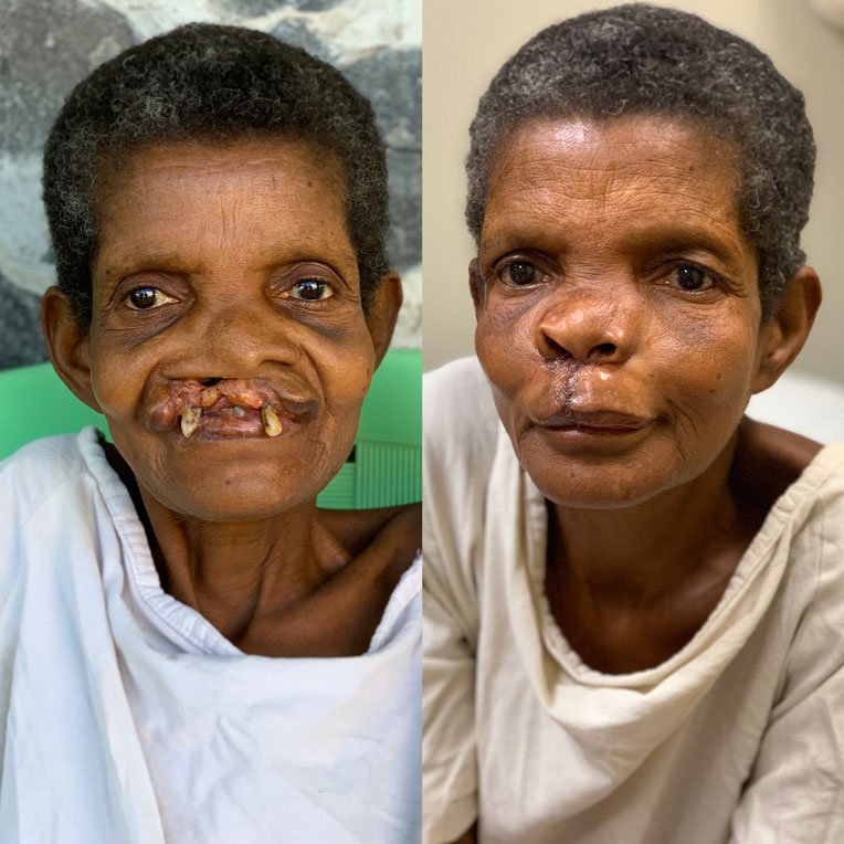 Before and after Secoh’s cleft lip surgery at ELWA.
